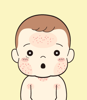 湿疹の自然治癒について