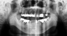 歯科のパノラマ撮影画像