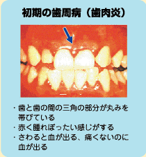 初期の歯周病（歯肉炎）・歯と歯の間の三角の部分が丸みを帯びている・赤く腫れぼったい感じがする・さわると血が出る、痛くないのに血が出る