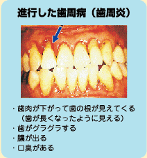 進行した歯周病（歯周炎）・歯肉が下がって歯の根が見えてくる（歯が長くなったように見える）・歯がグラグラする・膿が出る・口臭がある